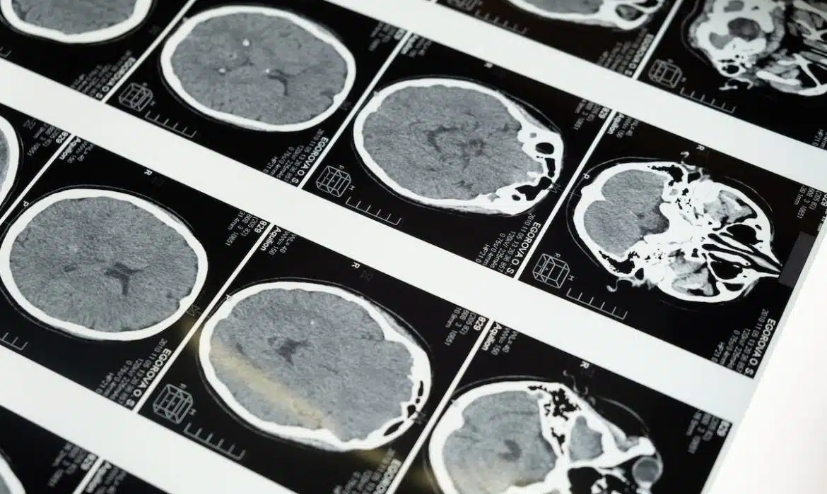 Comprendre les maladies neurodégénératives courantes chez les seniors