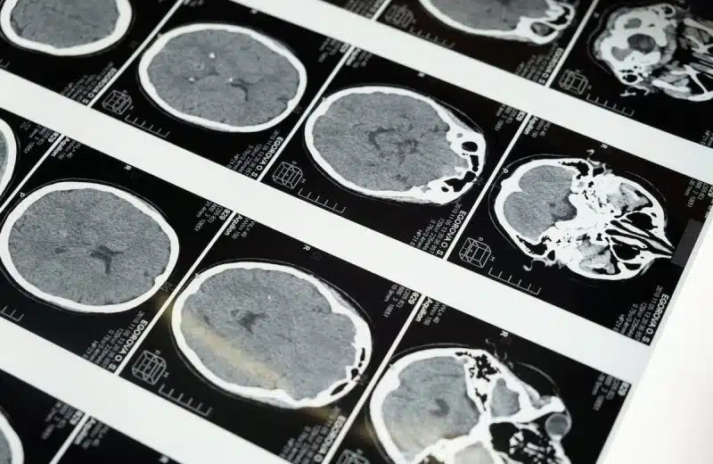 Comprendre les maladies neurodégénératives courantes chez les seniors