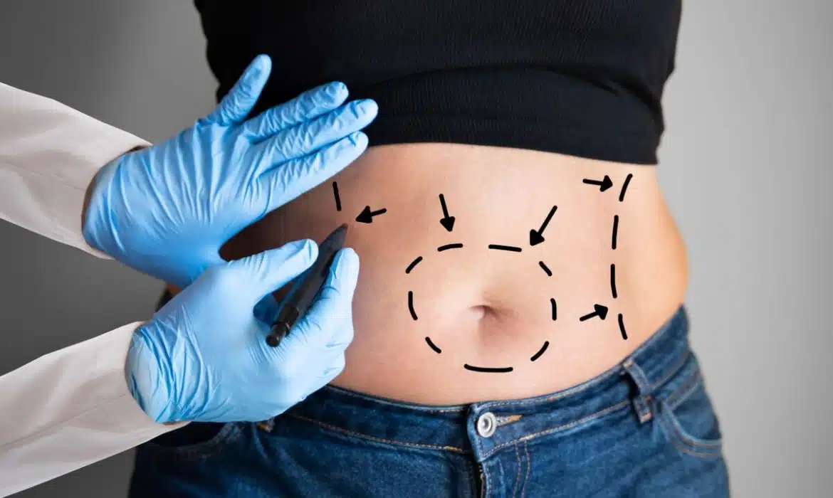 Quels médecins peuvent effectuer une Abdominoplastie ?