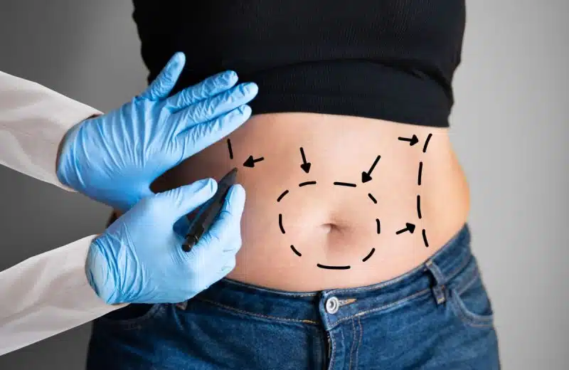 Quels médecins peuvent effectuer une Abdominoplastie ?