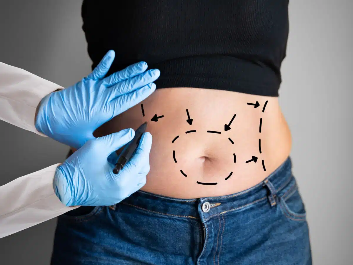 abdominoplastie