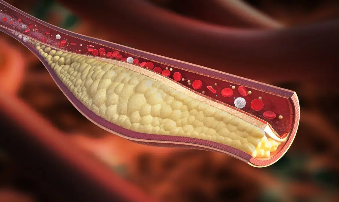 Quels sont les symptômes du taux élevé de cholestérol?