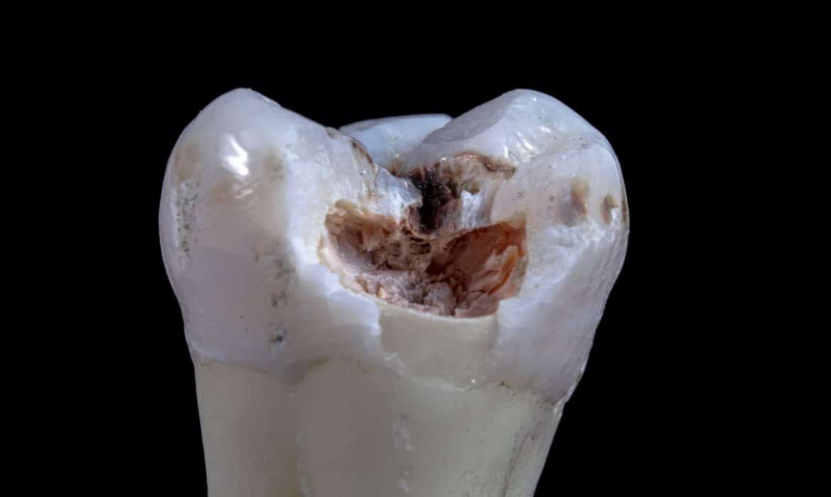 Comment faire pour réparer un trou dans sa dent ?