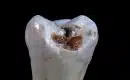 Comment faire pour réparer un trou dans sa dent ?