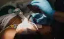 La rhinoplastie : comprendre les enjeux d’une chirurgie esthétique du nez